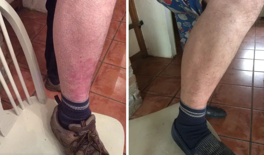 Icthyosis pictures