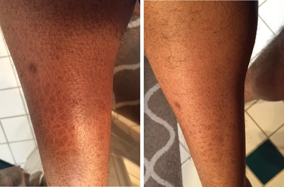 Ichthyosis Vulgaris Pictures G16 Lotion