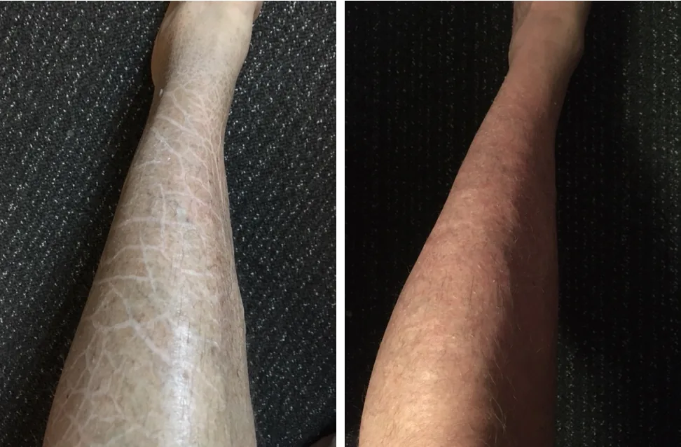 Ichthyosis Vulgaris Pictures G16 Lotion