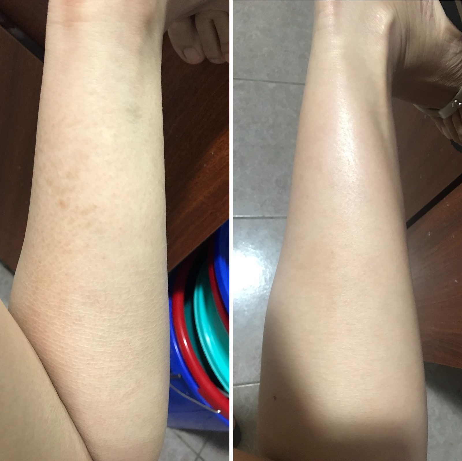 Hyperkeratosis