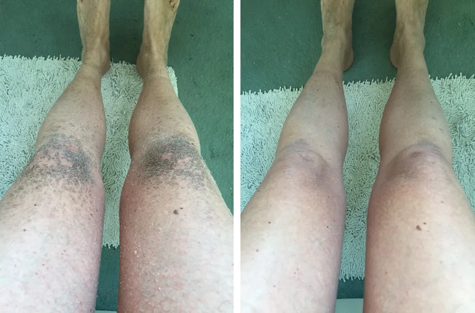 X Linked Ichthyosis Pictures