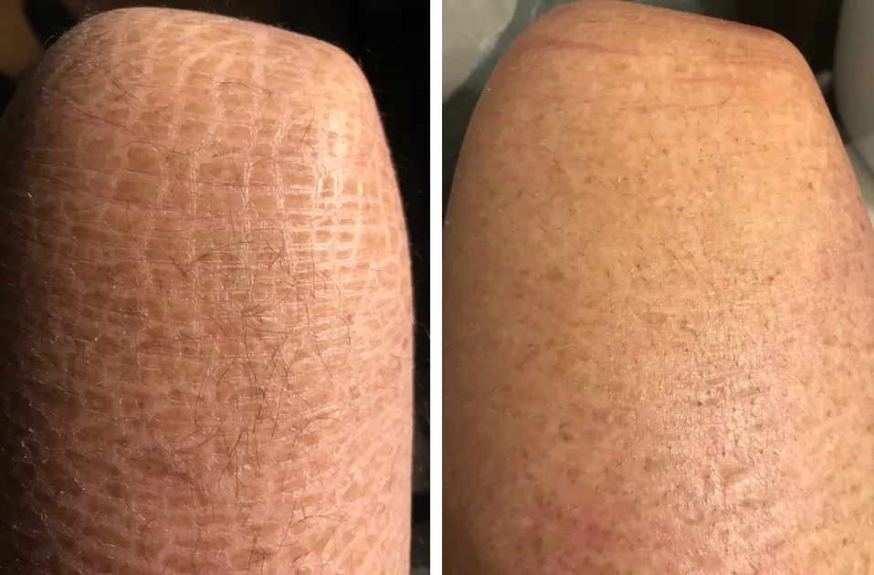 Best lotion for Ichthyosis
