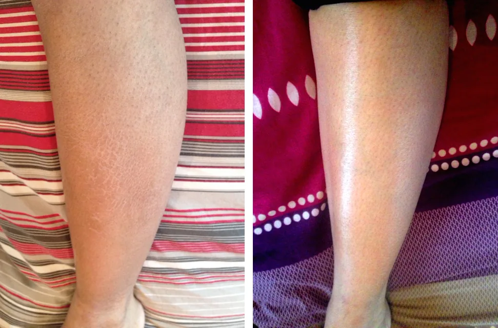 Skin before and after using G16 Skin Repair Lotion