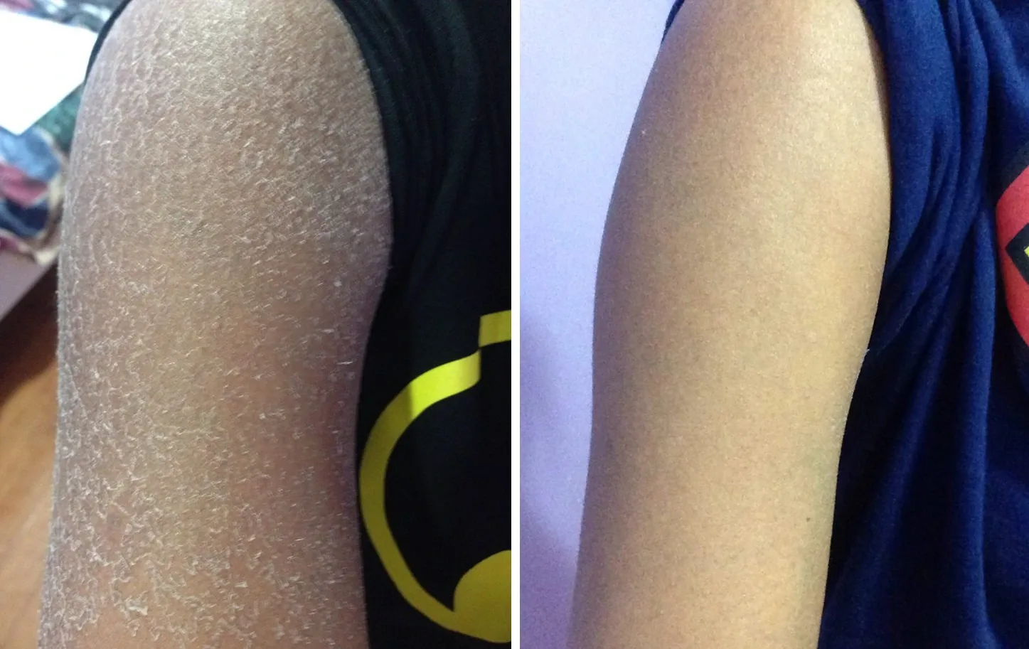 Ichthyosis pictures