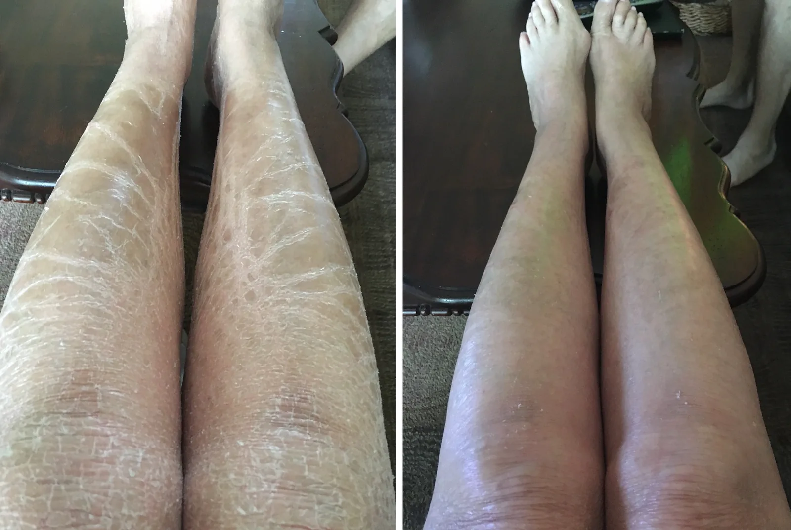 Ichthyosis Pictures G16 Lotion