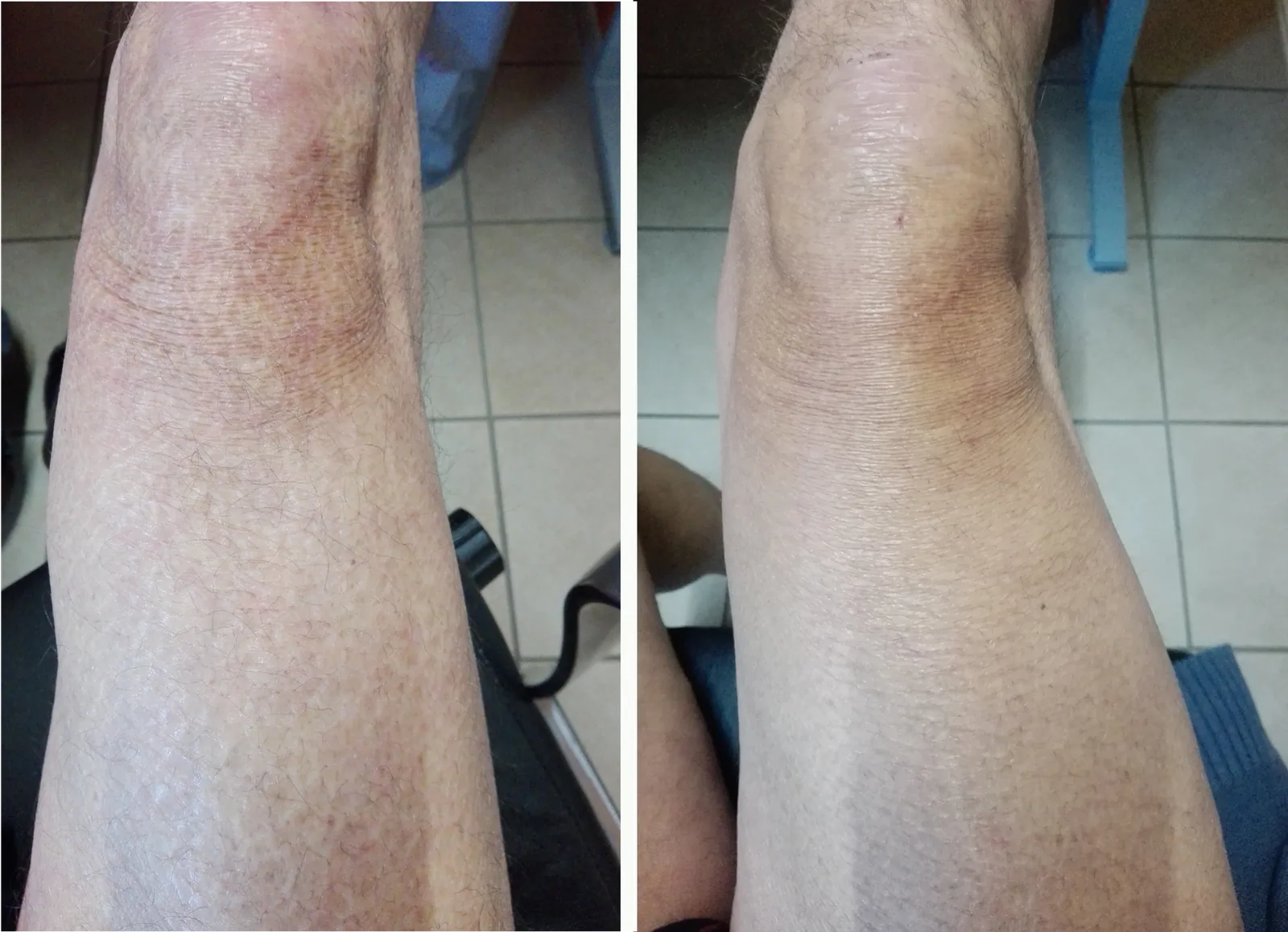 Ichthyosis