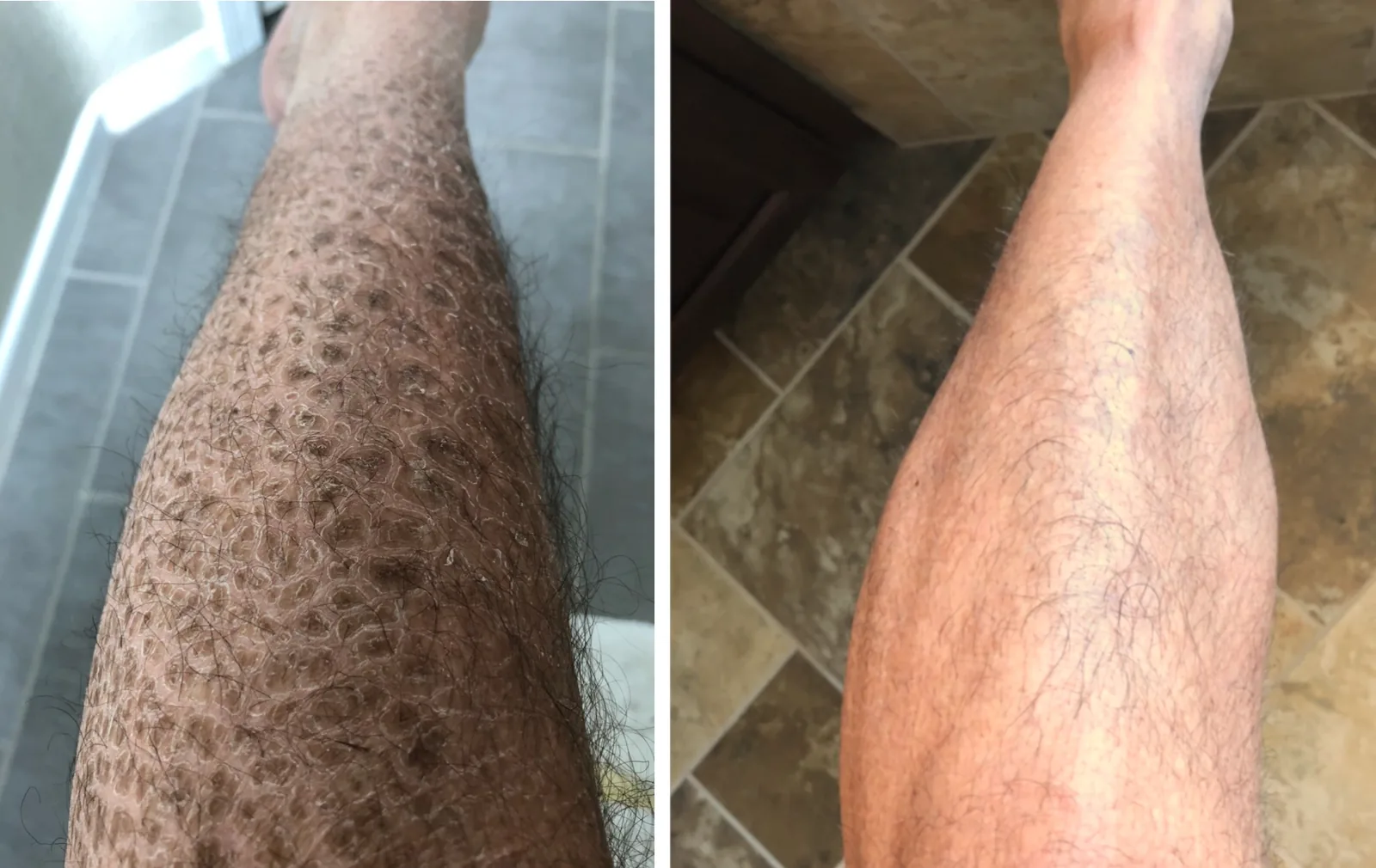 Dry Skin Ichthyosis