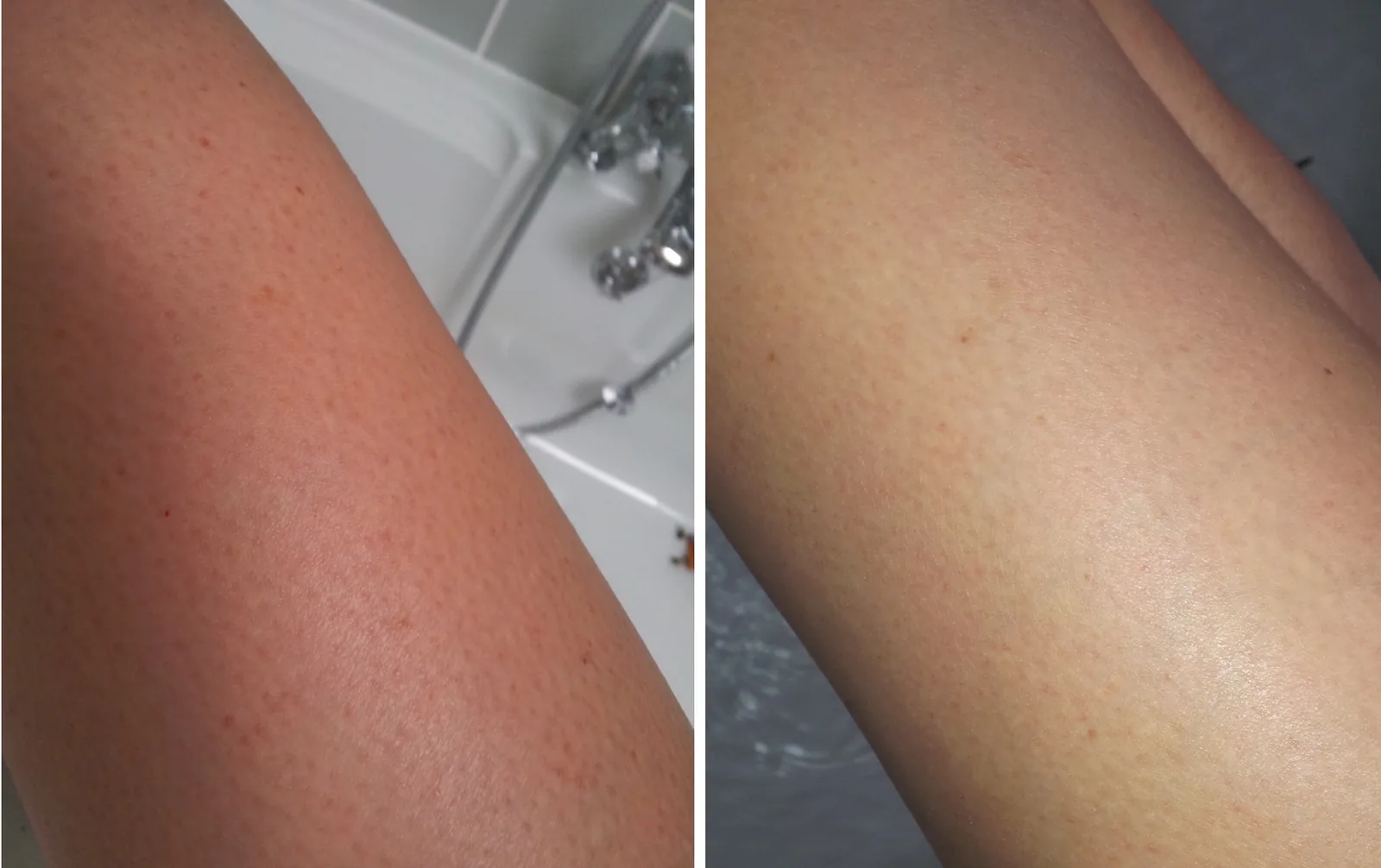 Keratosis Pilaris Pictures