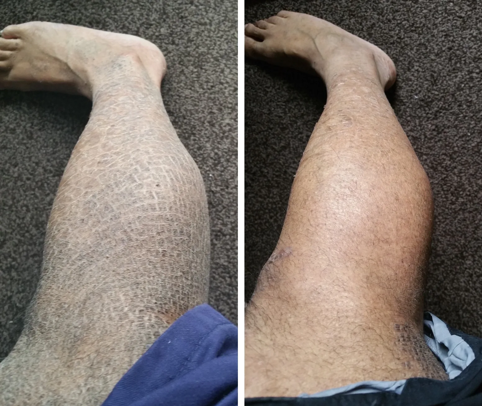 Lamellar Ichthyosis