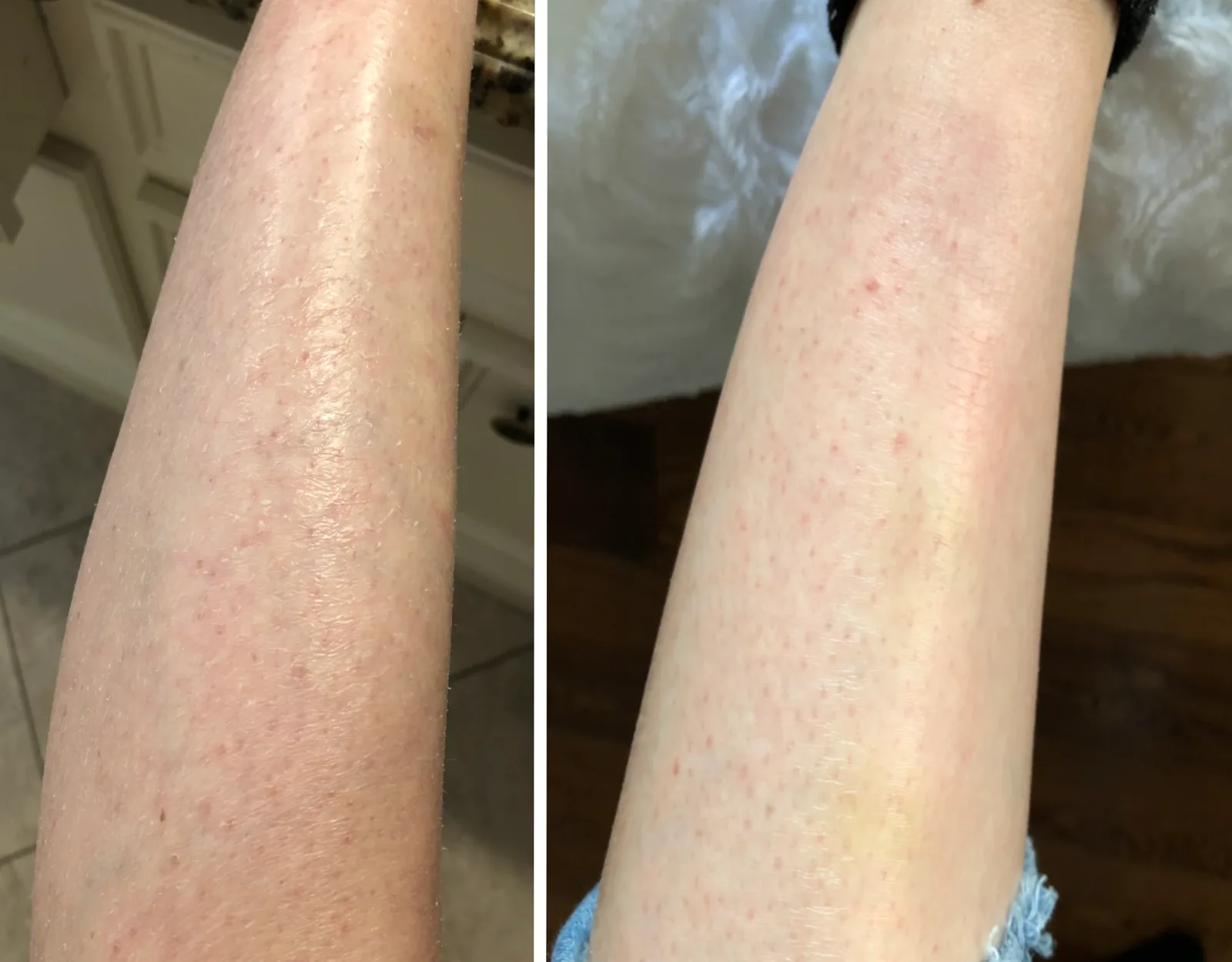 Ichthyosis pictures