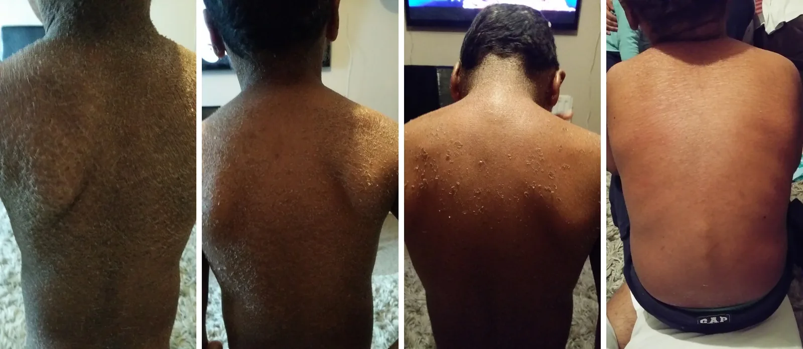 Lamellar Ichthyosis Pictures G16 Lotion