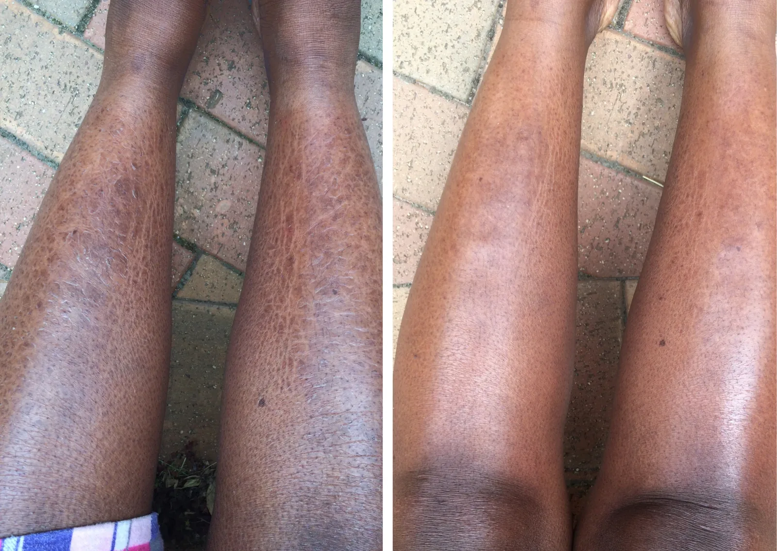 Ichthyosis treatment