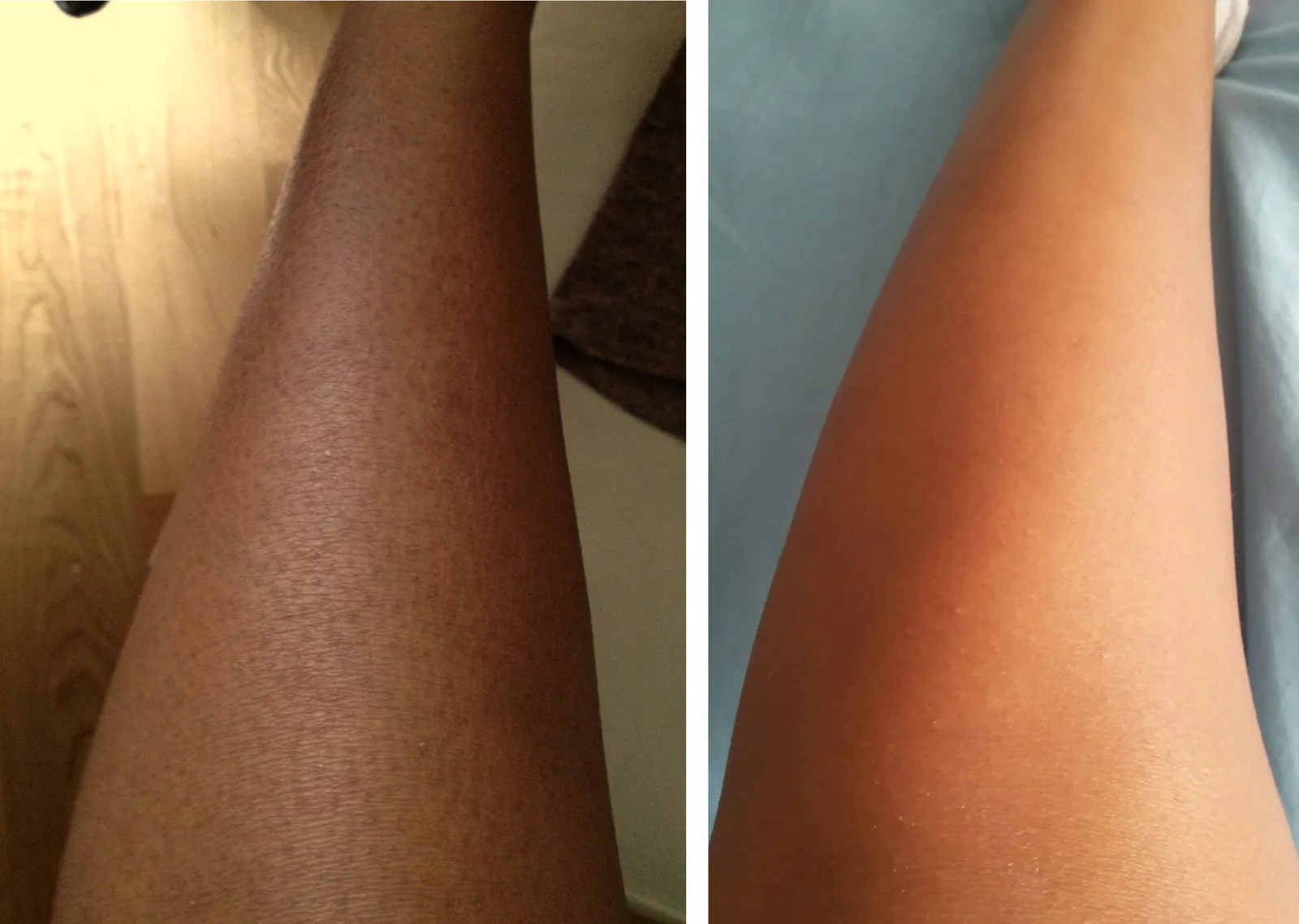 Ichthyosis Pictures