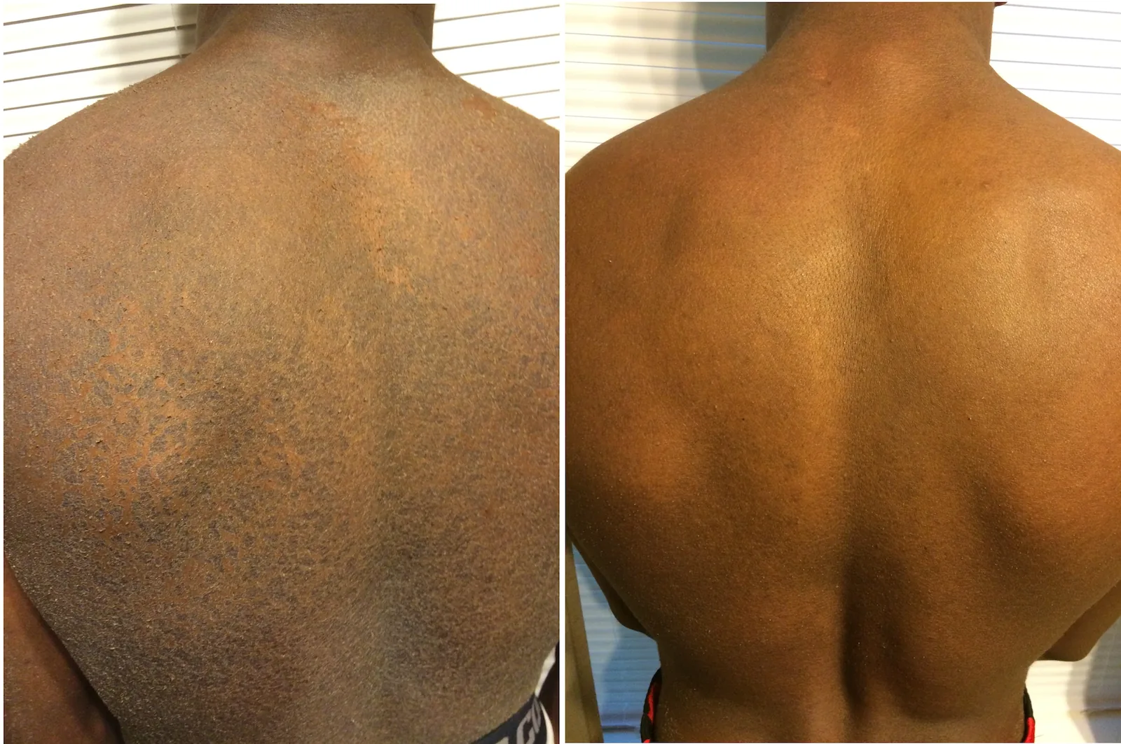 Best Ichthyosis Vulgaris Treatment