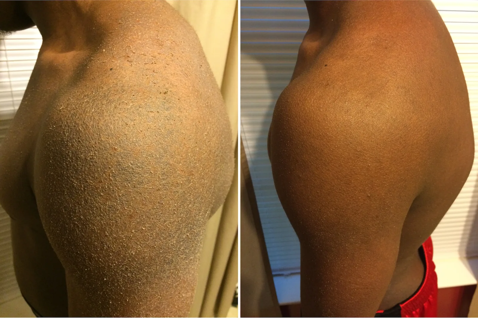 Best Ichthyosis Vulgaris Cream