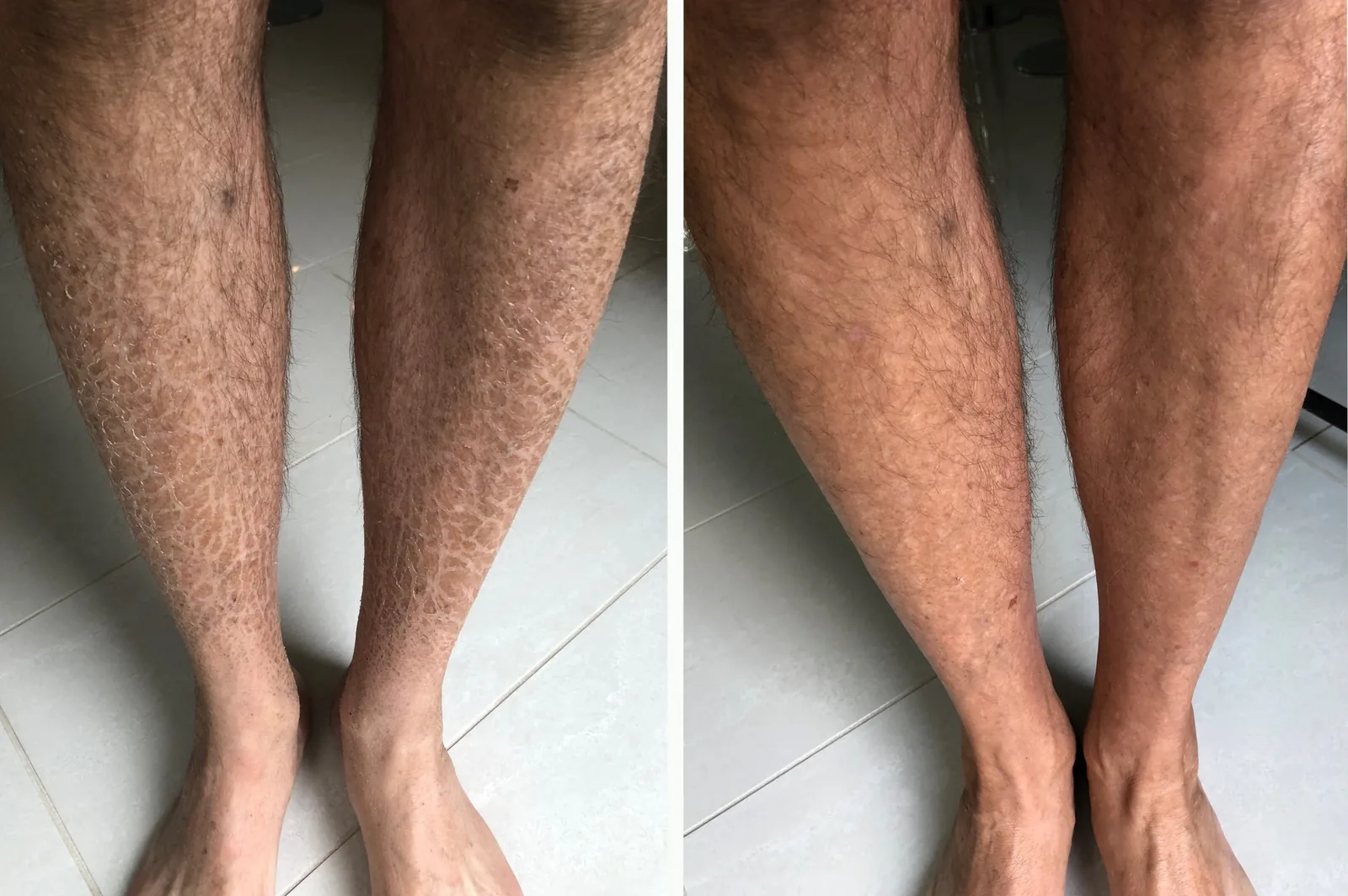 Dry skin lotion