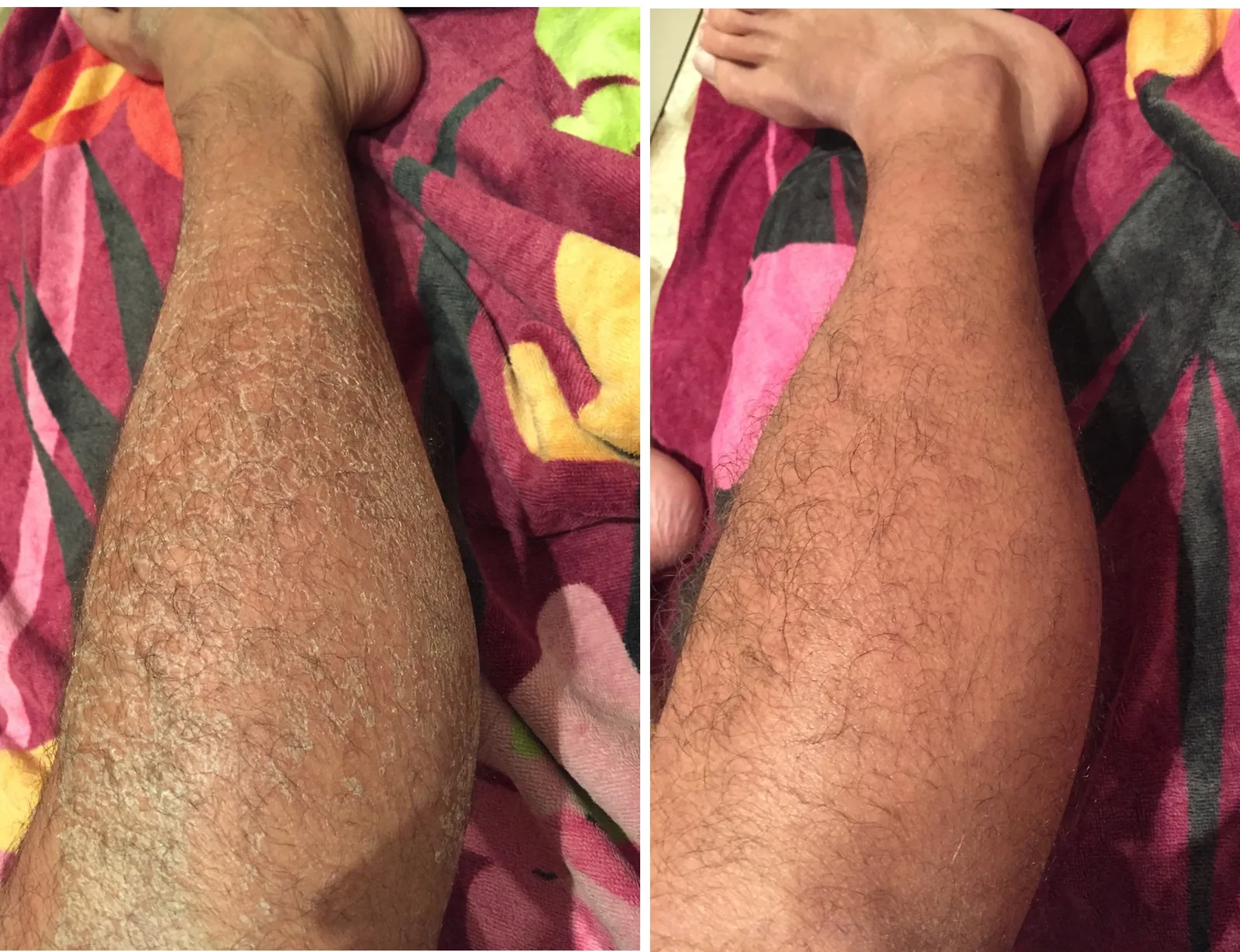 Ichthyosis Vulgaris Pictures