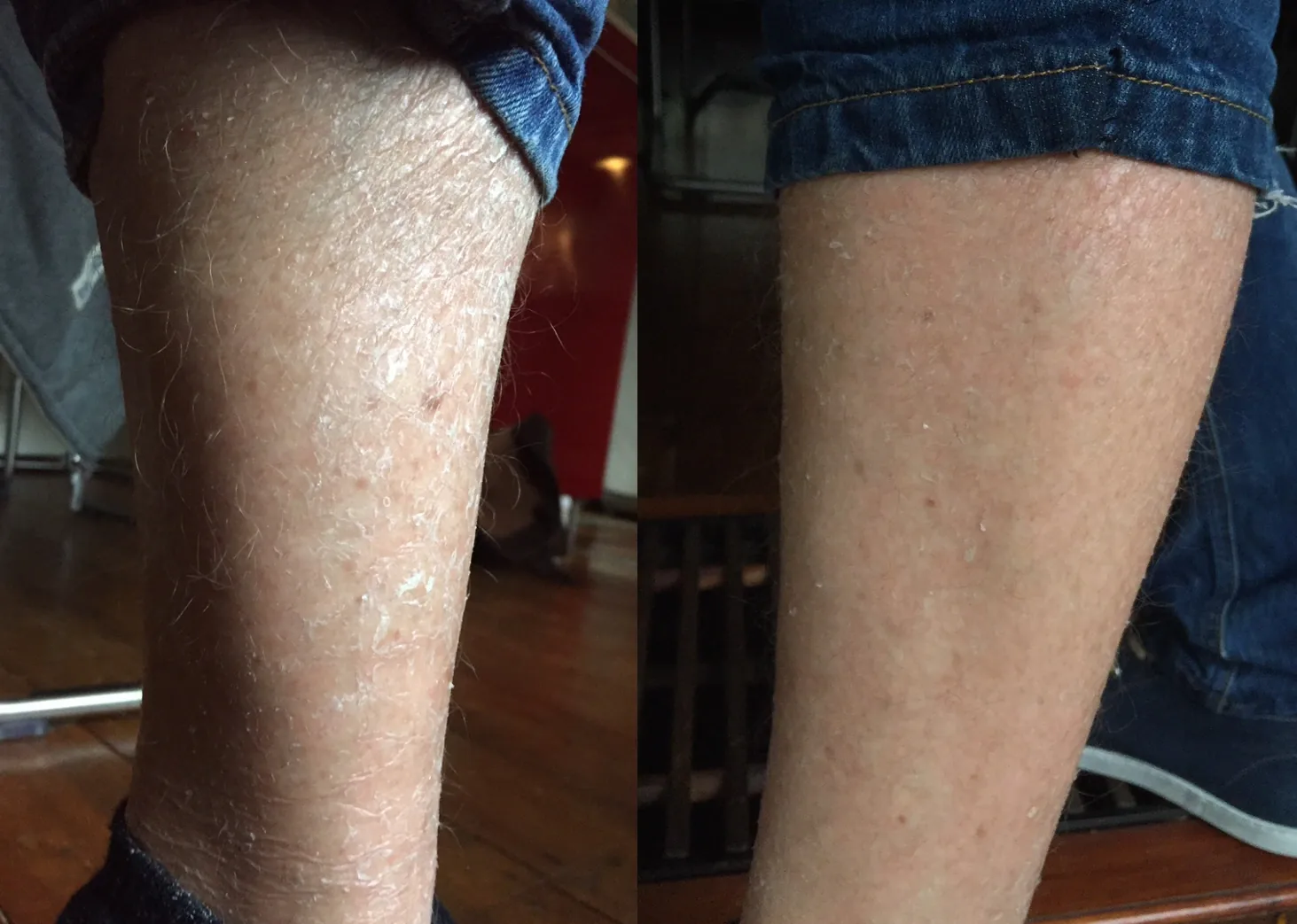 Ichthyosis Vulgaris