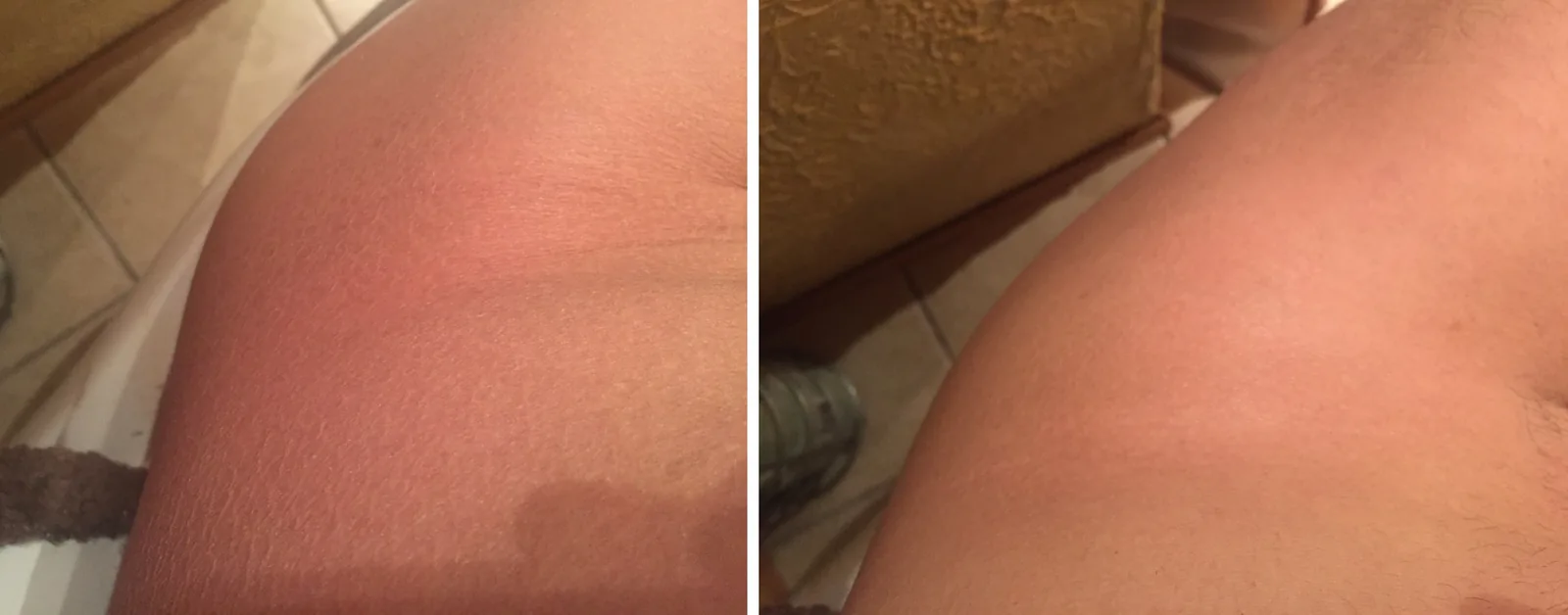 Ichthyosis Vulgaris pictures