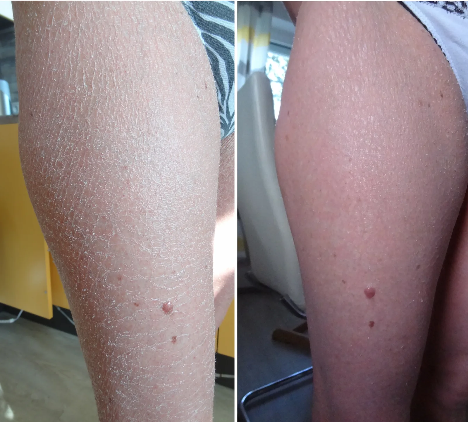 Ichthyosis Vulgaris Pictures