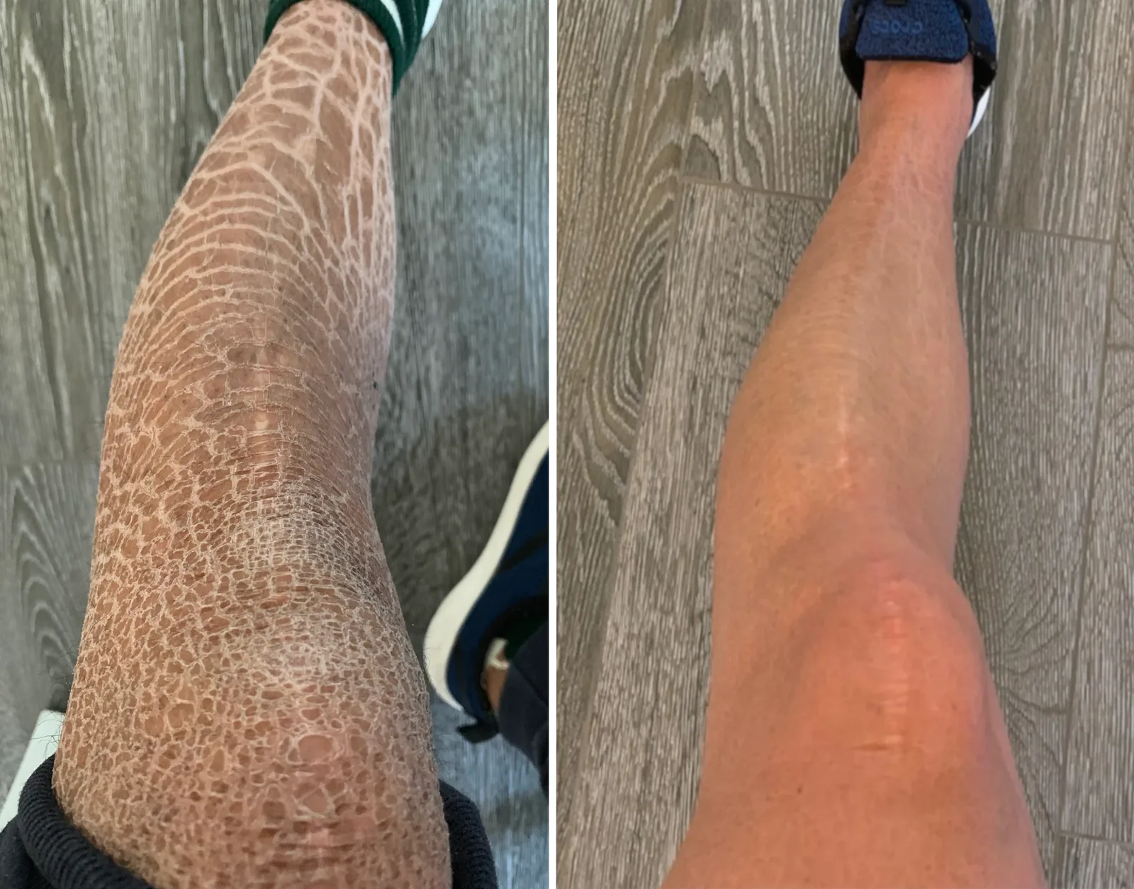 Skin before and after using G16 Skin Repair Lotion