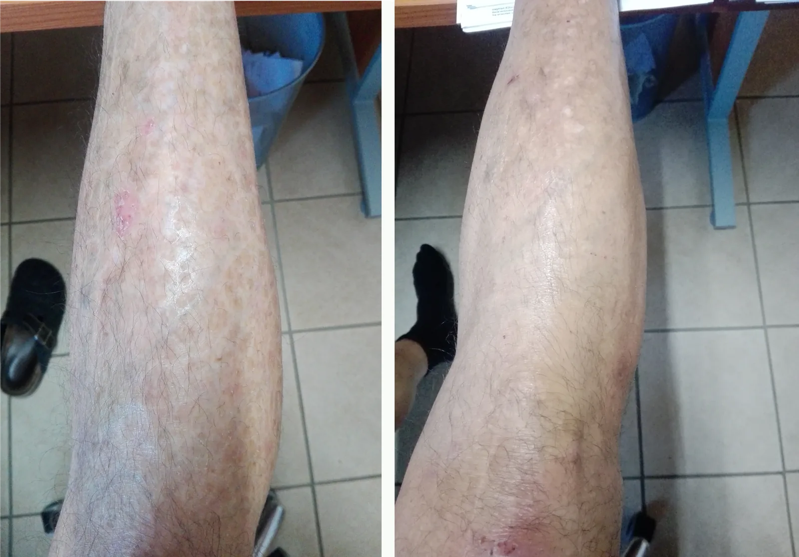 Ichthyosis vulgaris