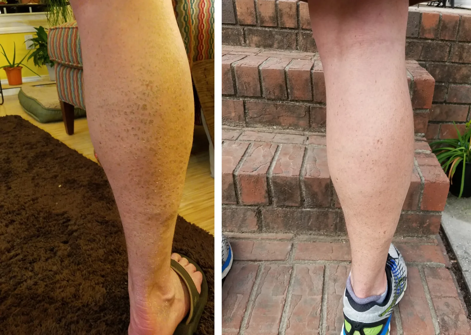 Best Ichthyosis treatment